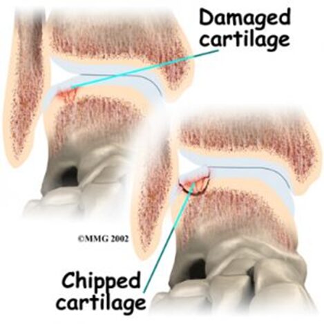 足首の関節軟骨の損傷